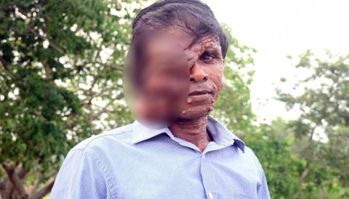 বিরল রোগে আক্রান্ত দিনমজুর, অর্থাভাবে হচ্ছেনা চিকিৎসা